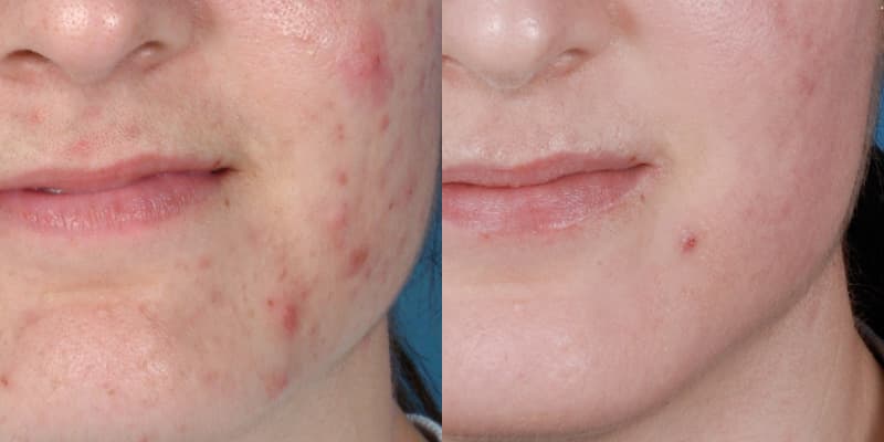 ZO® Skin Health Before & After