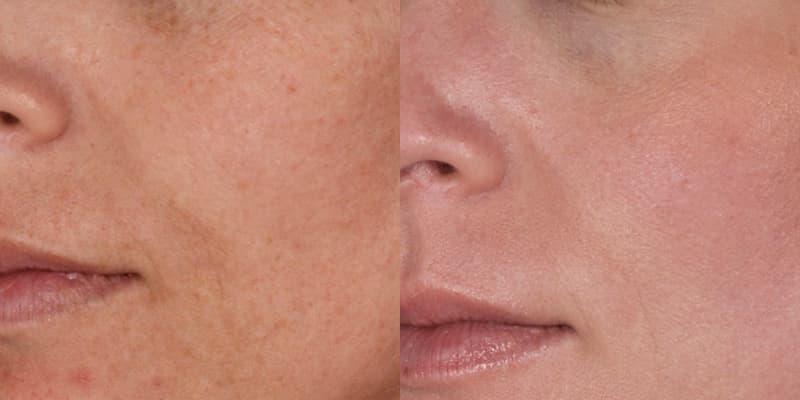 ZO® Skin Health Before & After