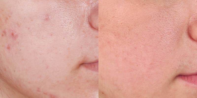 ZO® Skin Health Before & After