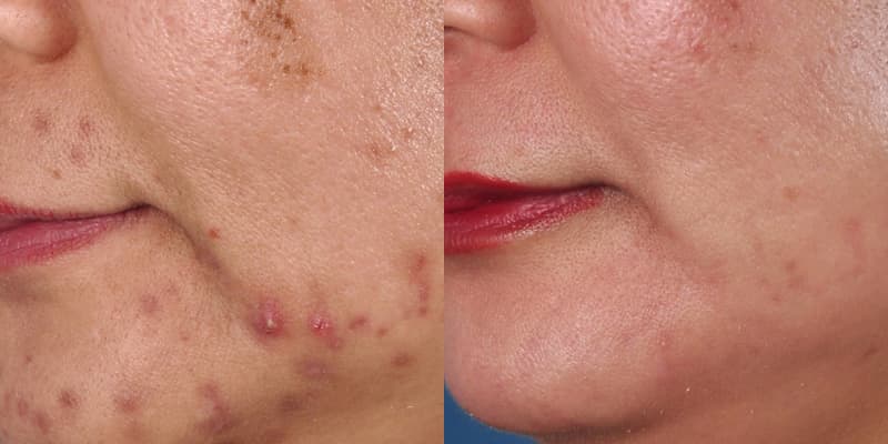 ZO® Skin Health Before & After