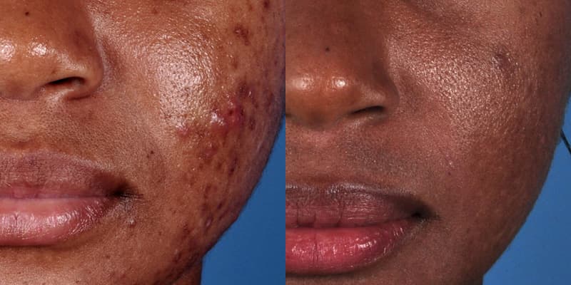 ZO® Skin Health Before & After