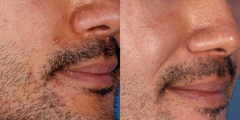 ZO® Skin Health Before & After