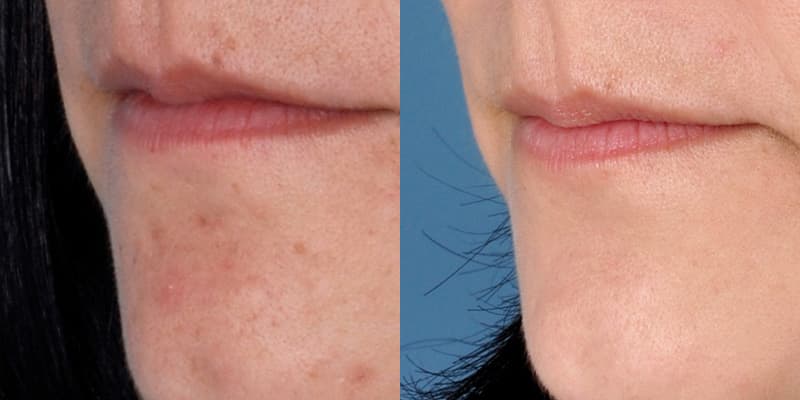 ZO® Skin Health Before & After