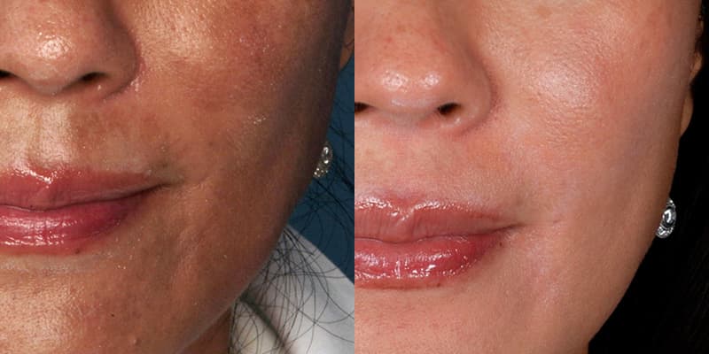 ZO® Skin Health Before & After