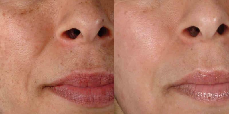 ZO® Skin Health Before & After