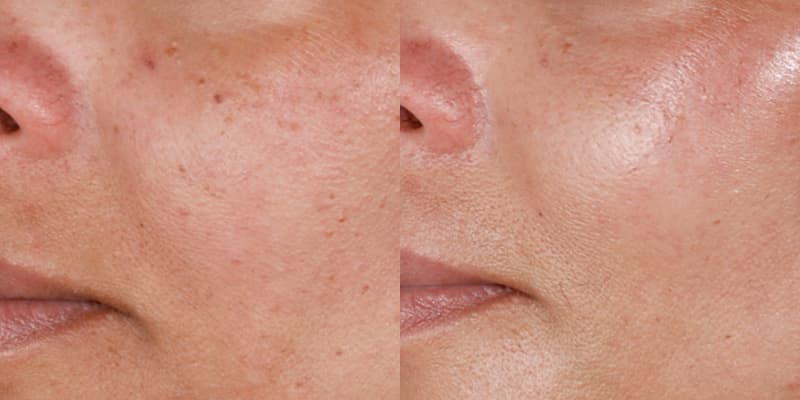 ZO® Skin Health Before & After
