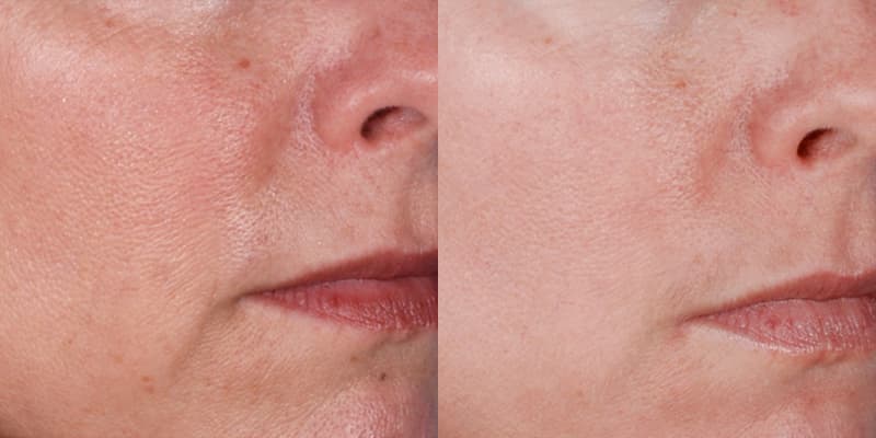ZO® Skin Health Before & After