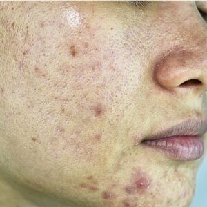 Acne on Face
