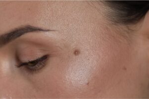 Targeting Benign Lesions: A Reader’s Guide to Hyfrecation/ Cautery.