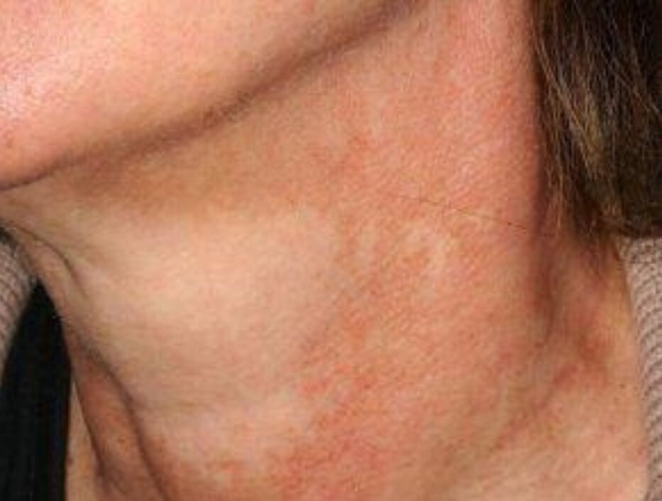 Poikiloderma of Civatte