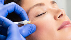 Botox treatment